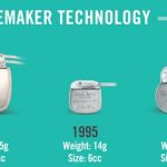 Leadless Pacemaker technology